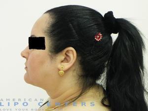 americanlipocenters_149.jpg